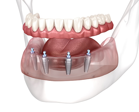 Illustration of dentures and dental implants for All-on-4 in Dallas, TX