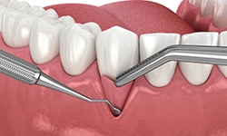 Illustration of graft being placed at site of gum recession