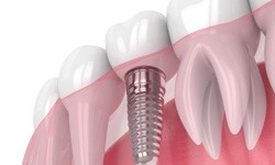 Illustration of a single dental implant in Dallas, TX