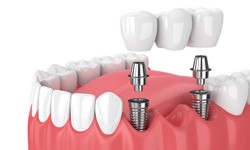 Two dental implants in Dallas, TX being used to support a dental bridge