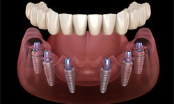 Illustration of full denture being attached to dental implants in Dallas, TX