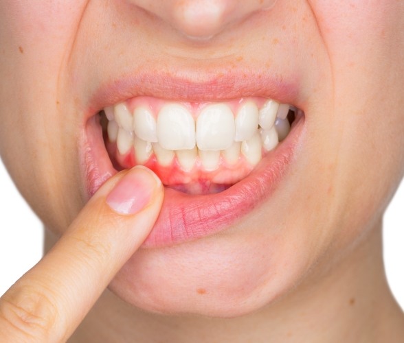 Patient pointing to smile with damaged gums due to periodontal disease