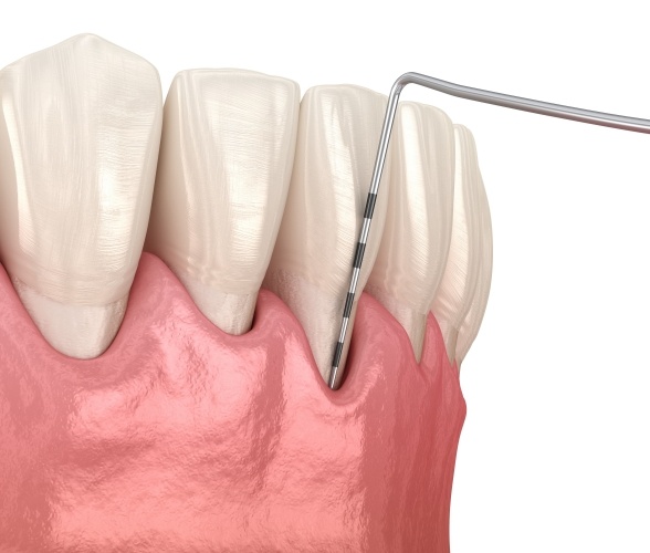Animated smile during periodontal maintenance