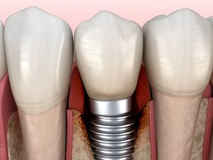 Failing dental implant, may need to be removed