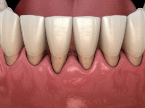 Model of patient with gum recession 